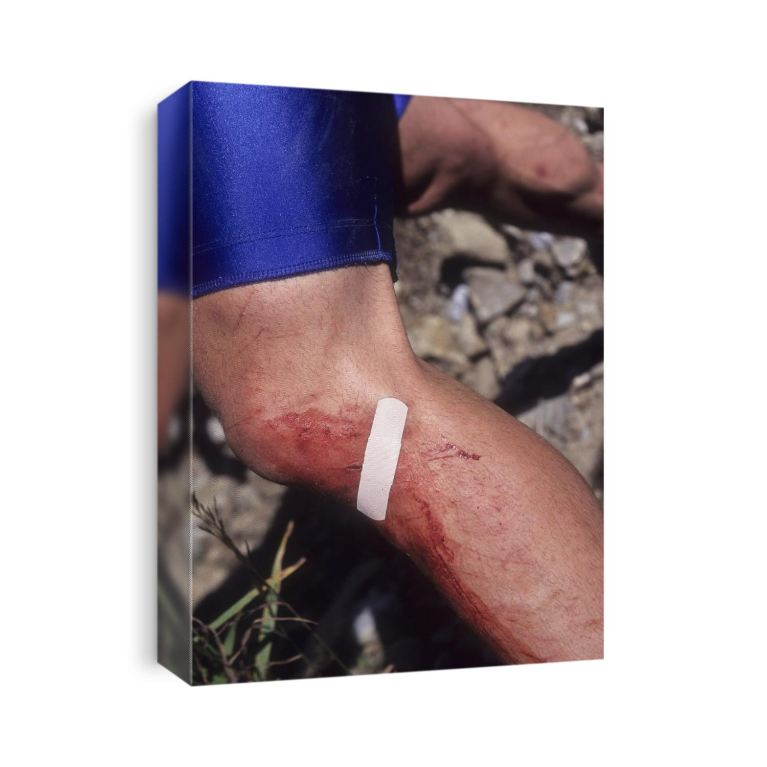 Injured mountain bicycllist.